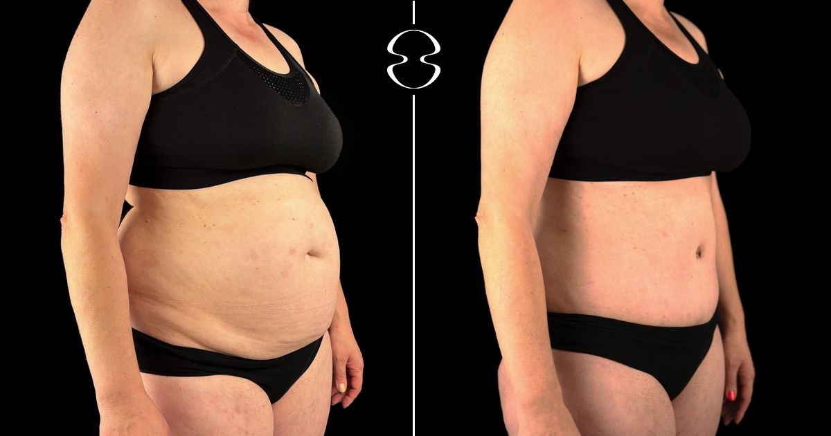 antes e depois lipoaspiração lipoabdominoplastia