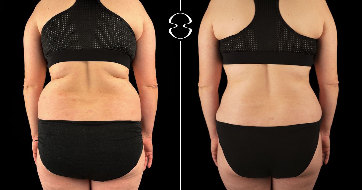 antes e depois lipoaspiração lipoabdominoplastia