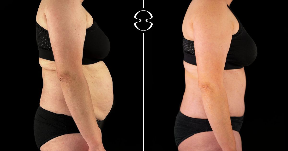 antes e depois lipoaspiração lipoabdominoplastia
