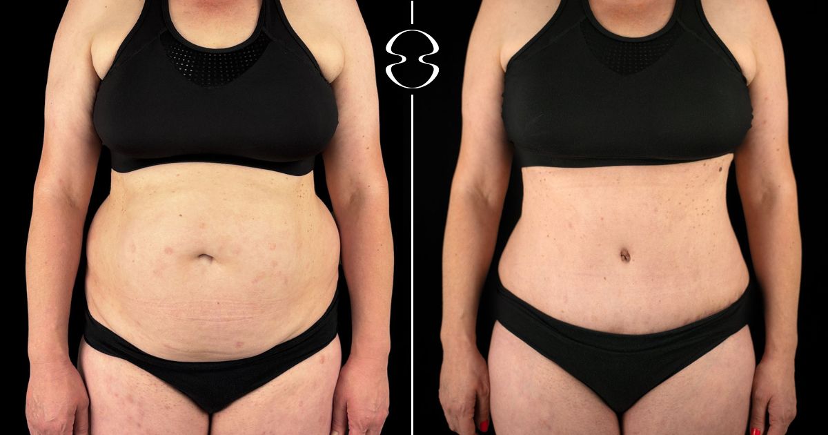 antes e depois lipoaspiração lipoabdominoplastia