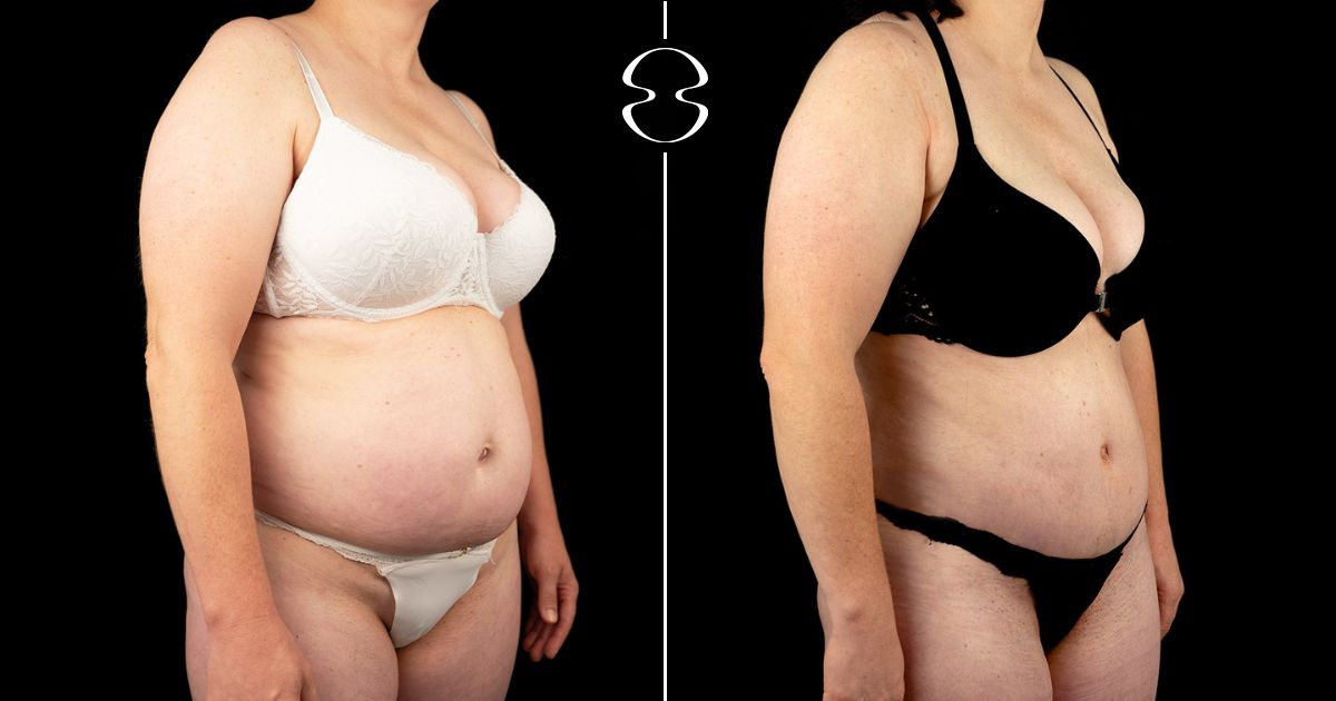 Sandra Figueiredo Antes e Depois Lipoaspiração e Lipoabdominoplastia