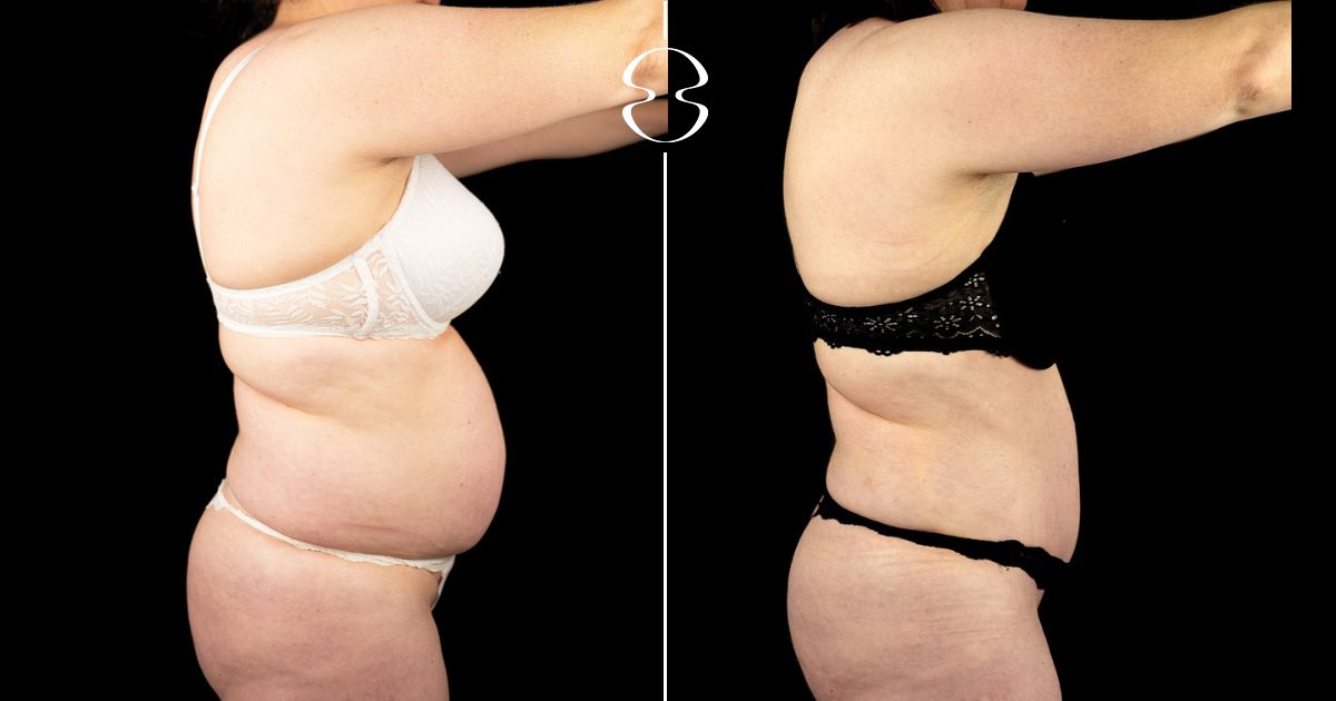 Sandra Figueiredo Antes e Depois Lipoaspiração e Lipoabdominoplastia