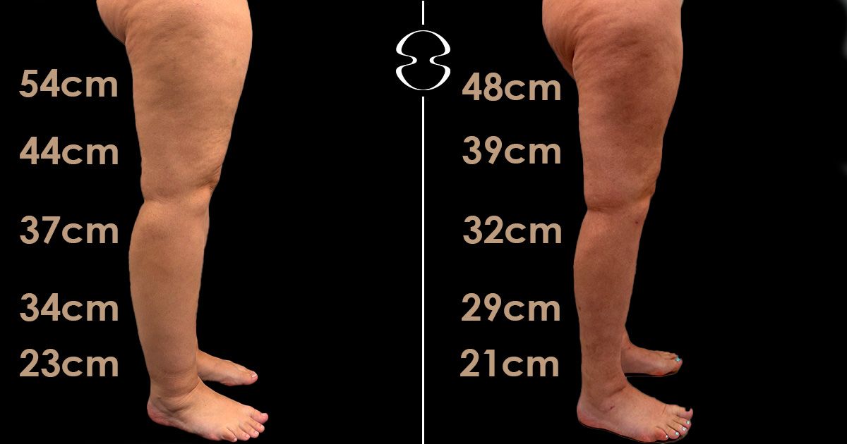 lipedema antes e depois