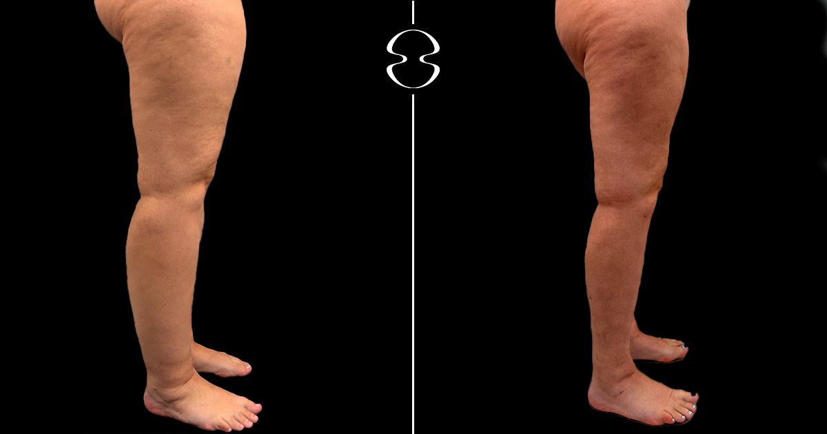 lipedema antes e depois