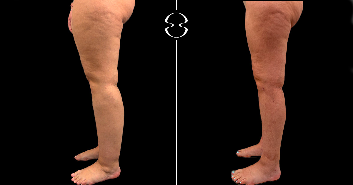 lipedema antes e depois
