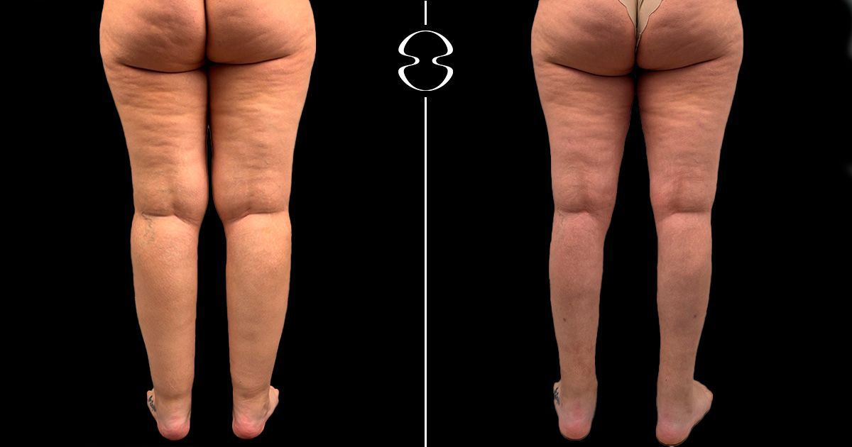 lipedema antes e depois