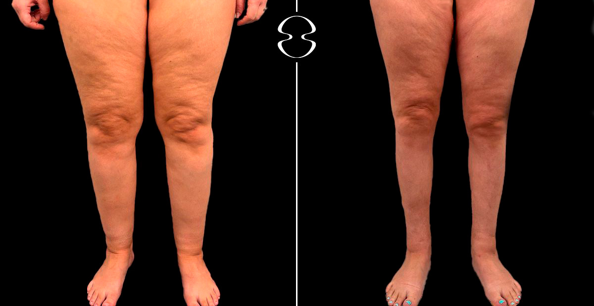 lipedema antes e depois