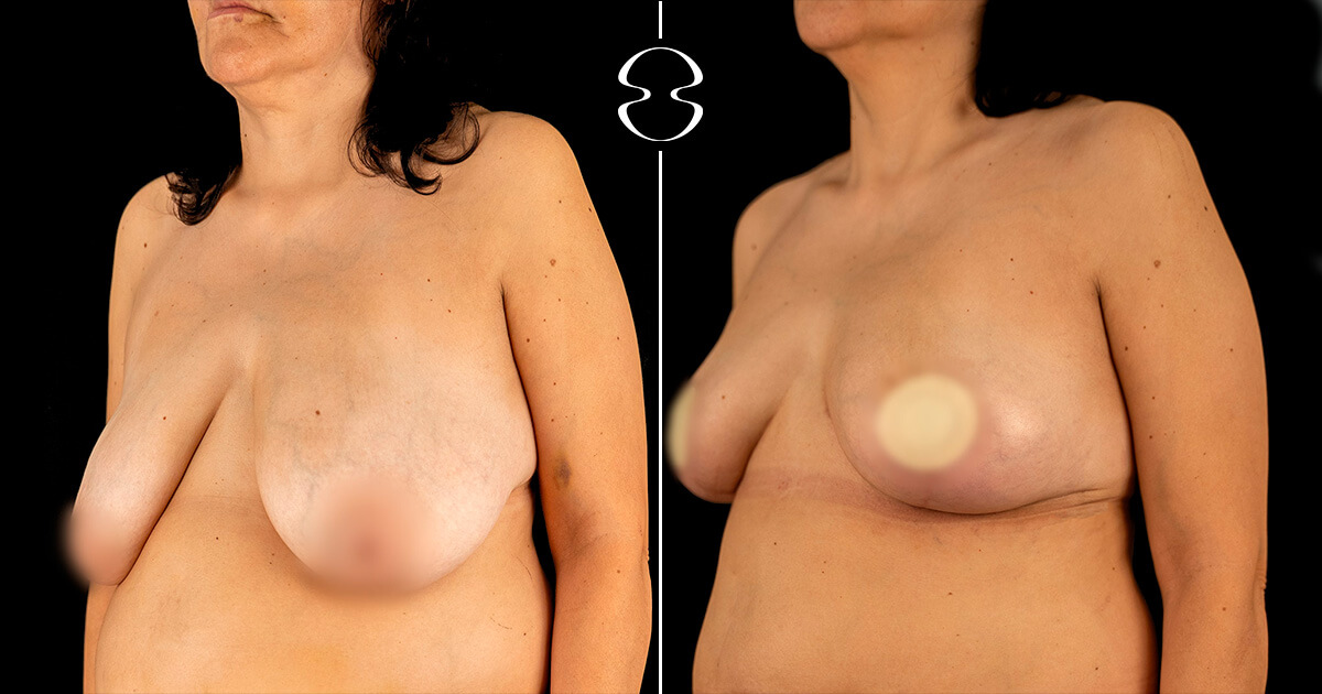 foto antes e depois de mamoplastia de redução Ana Paula Silva