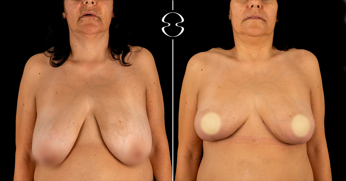 foto antes e depois de mamoplastia de redução Ana Paula Silva