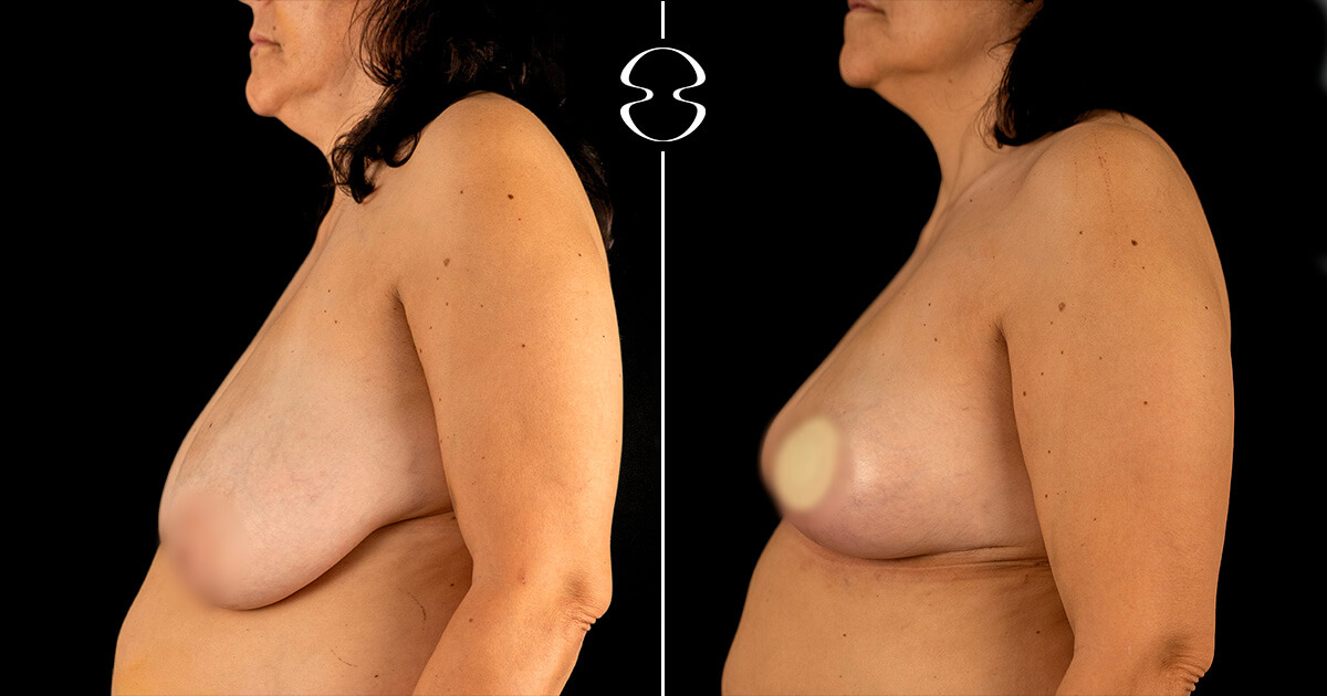 foto antes e depois de mamoplastia de redução Ana Paula Silva