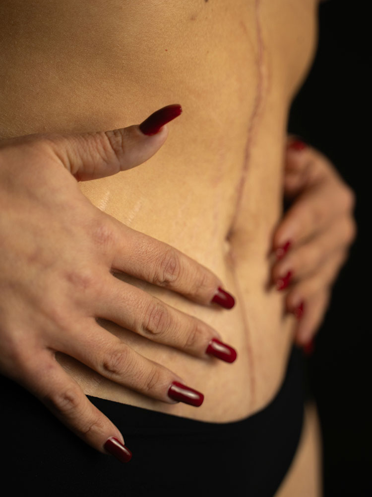 Liliana Carromeu depois MyMoment