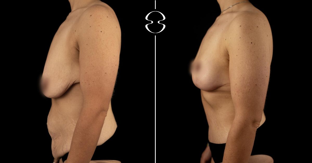 Liliana Carromeu antes e depois MyMoment