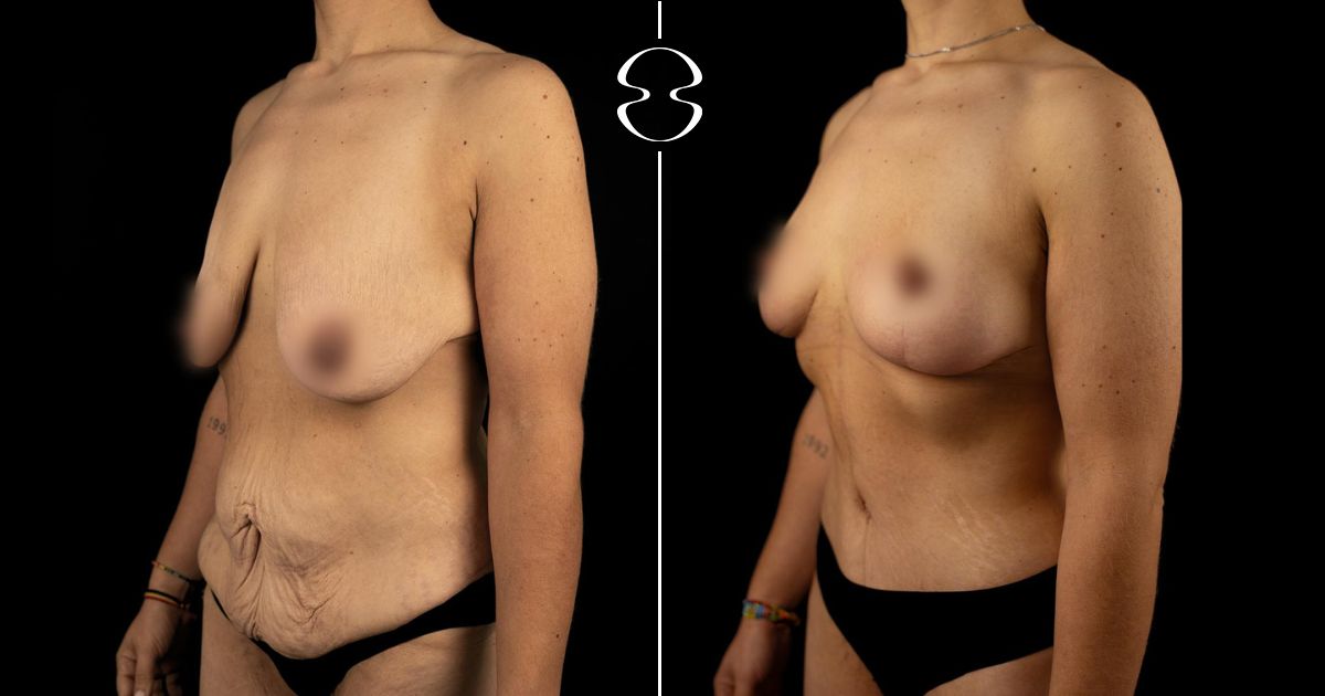 Liliana Carromeu antes e depois MyMoment