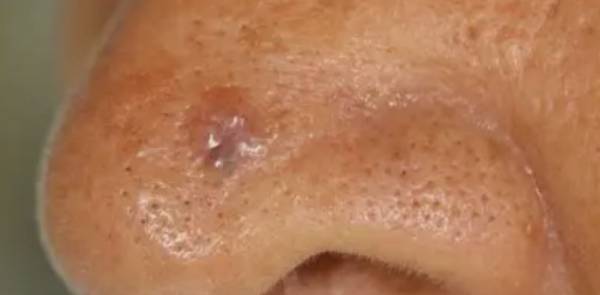 Carcinoma basocelular