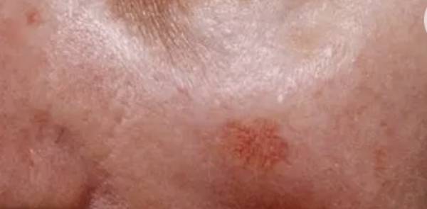 Carcinoma Espinocelular