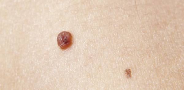 Nevos melanocíticos