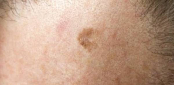 melanoma