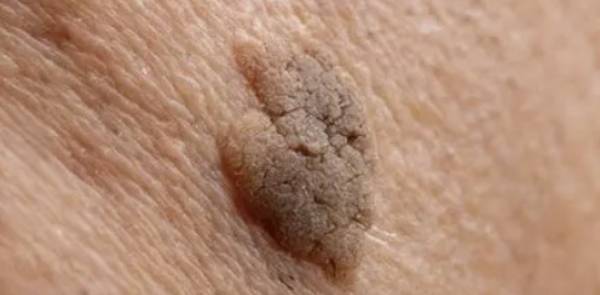 queratose seborreica