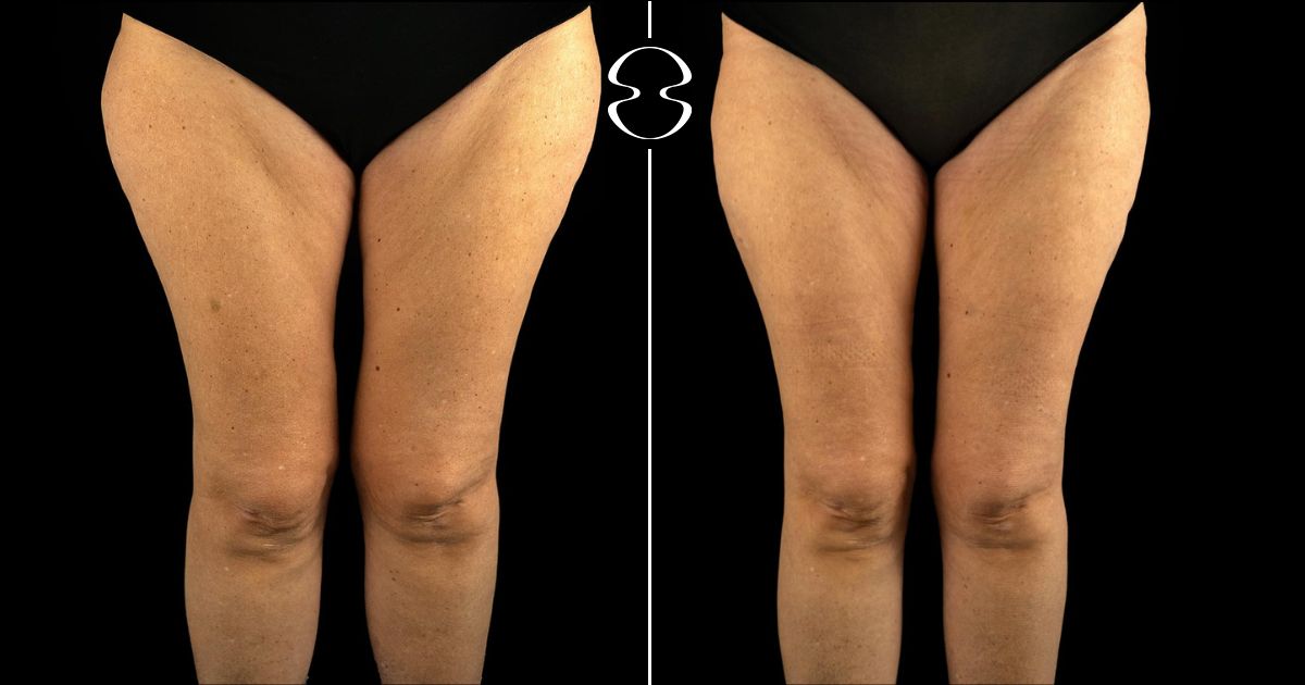lipoaspiracao coxas e joelho antes e depois