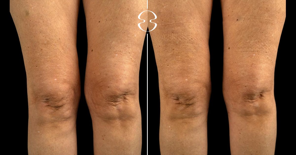 lipoaspiracao coxas e joelho antes e depois