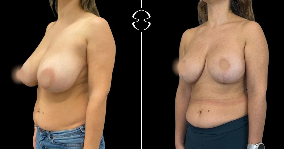 mamoplastia de redução caso antes e depois
