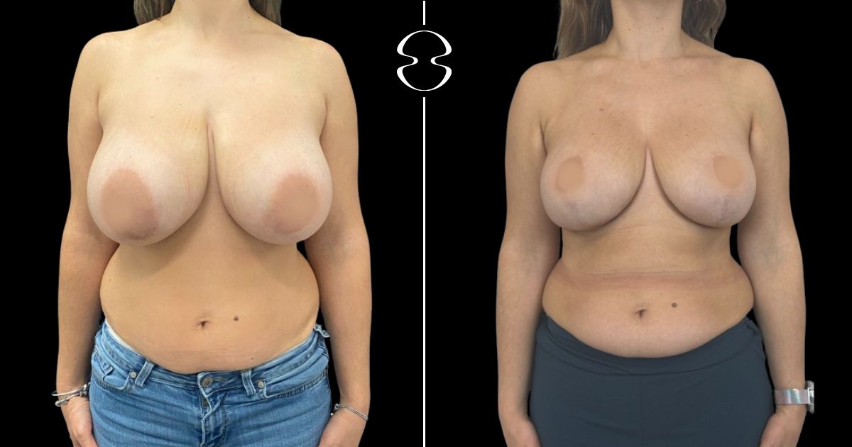 mamoplastia de redução caso antes e depois