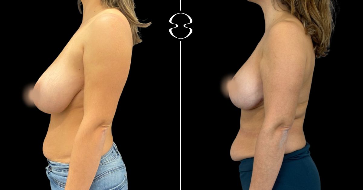 mamoplastia de redução caso antes e depois