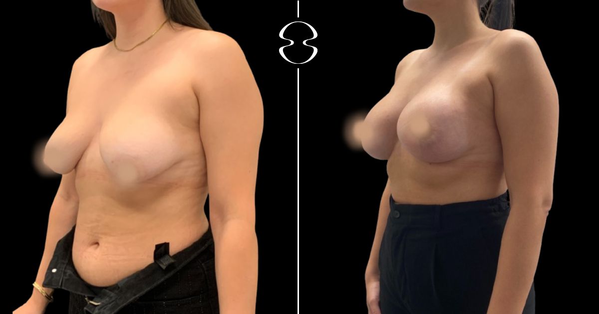 mastopexia caso antes e depois