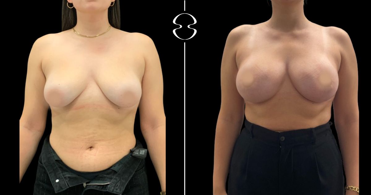 mastopexia caso antes e depois