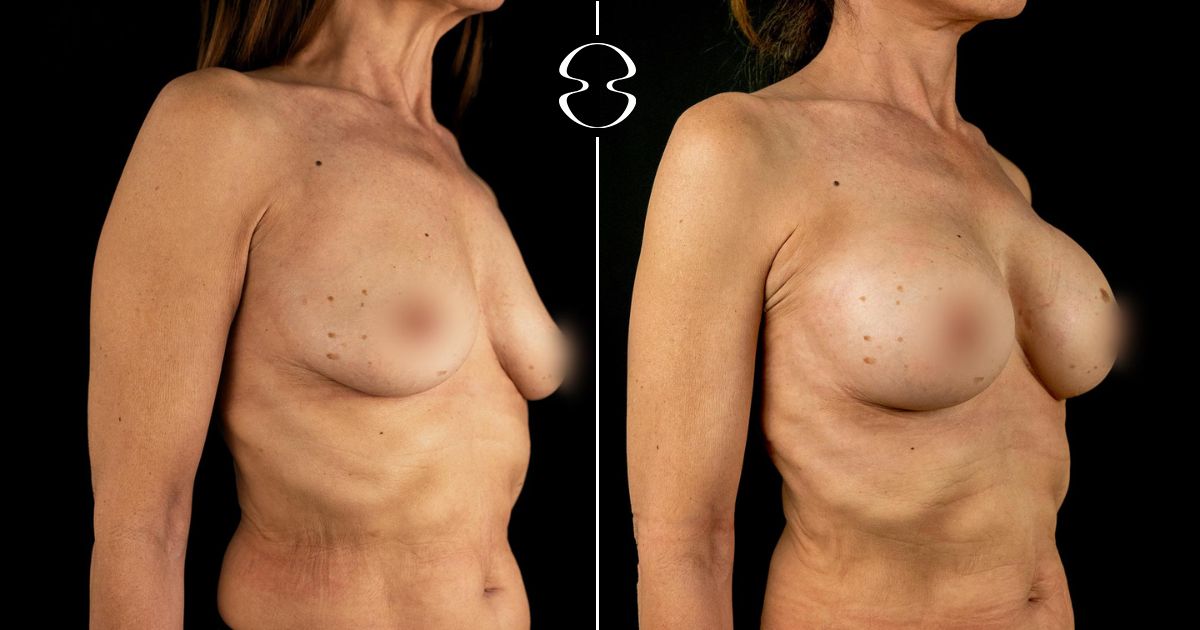 mamoplastia de aumento antes e depois
