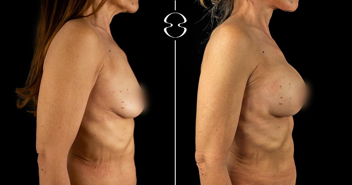 mamoplastia de aumento antes e depois