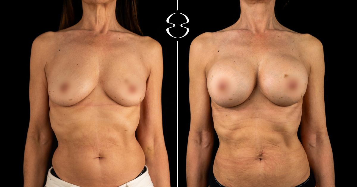mamoplastia de aumento antes e depois