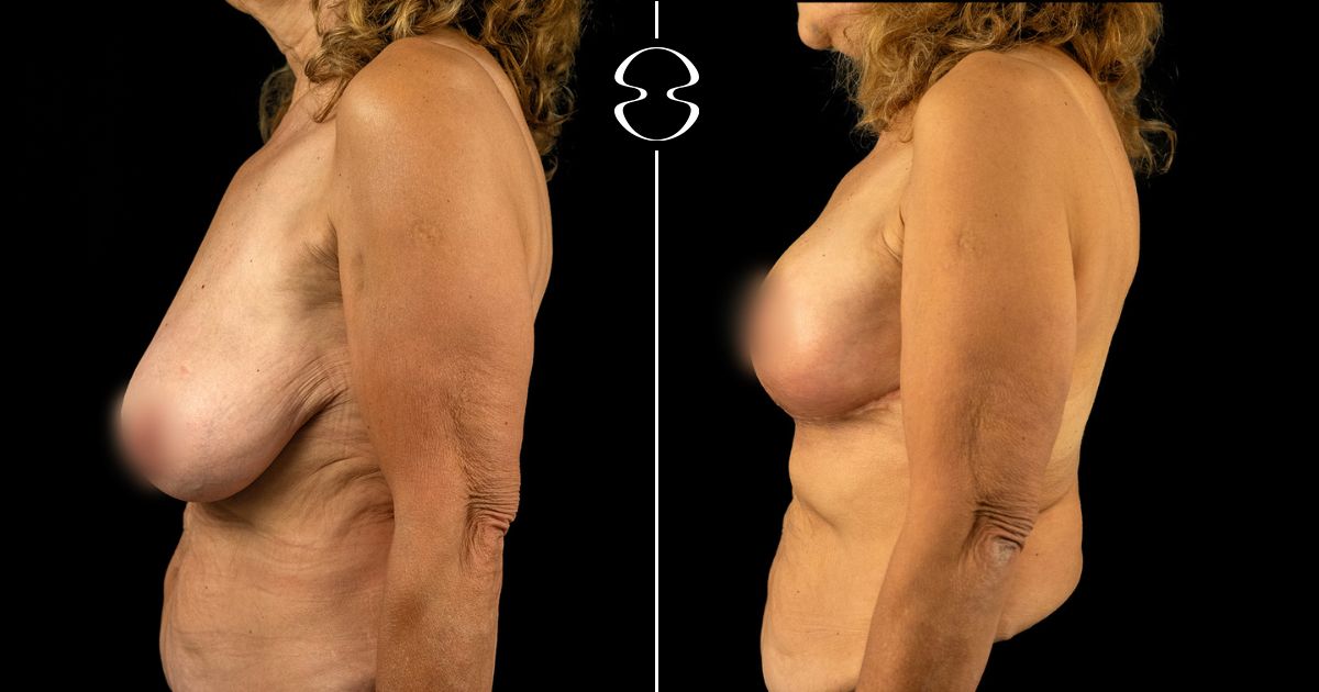 Mastopexia Fotos Antes e Depois