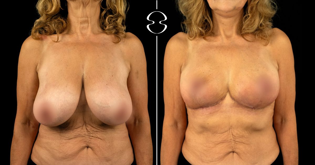 Mastopexia Fotos Antes e Depois
