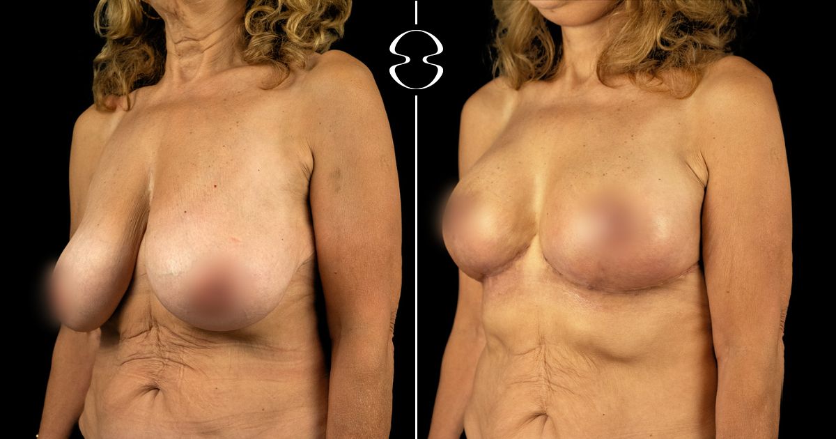 Mastopexia Fotos Antes e Depois