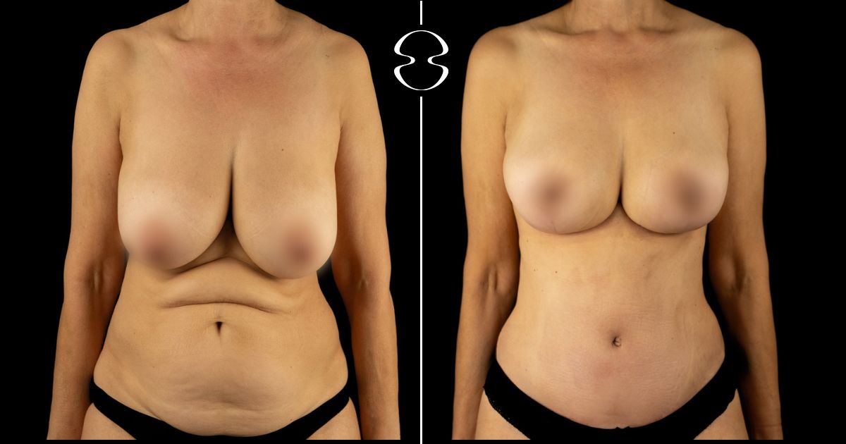 maria goreti santos antes e depois