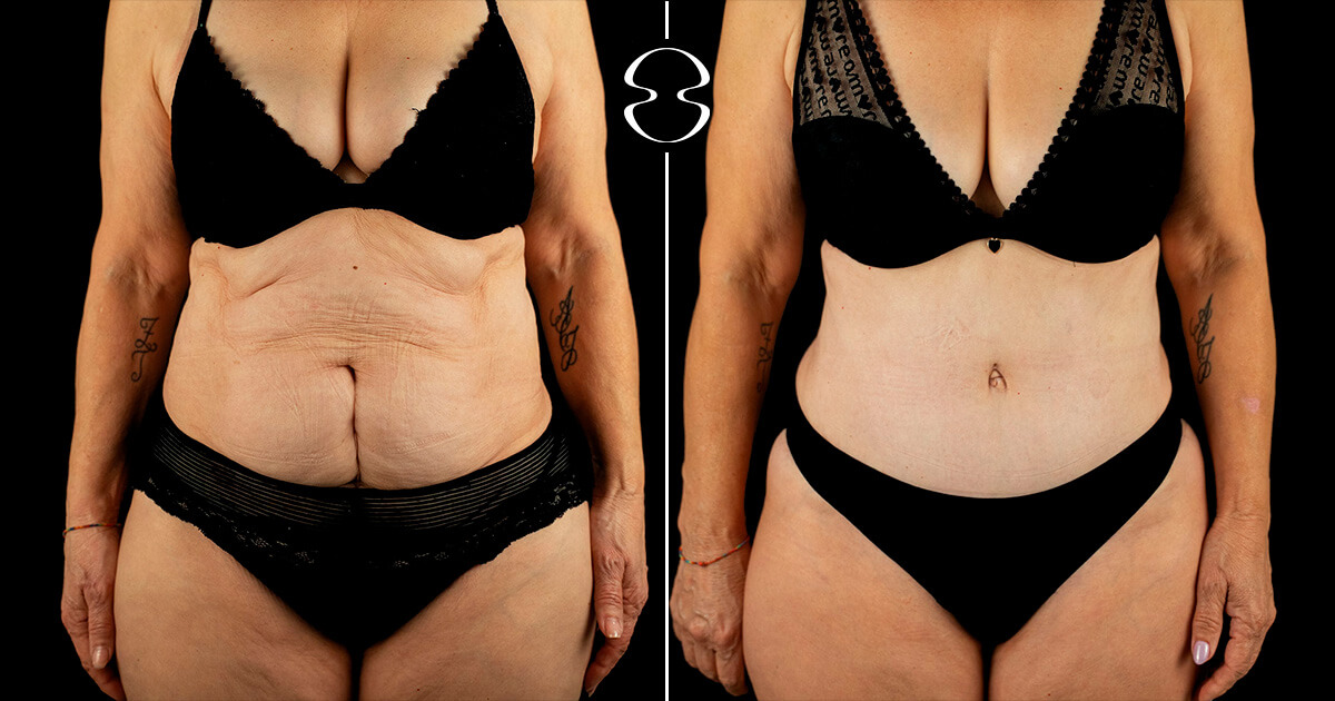 Lipoaspiração caso antes e depois