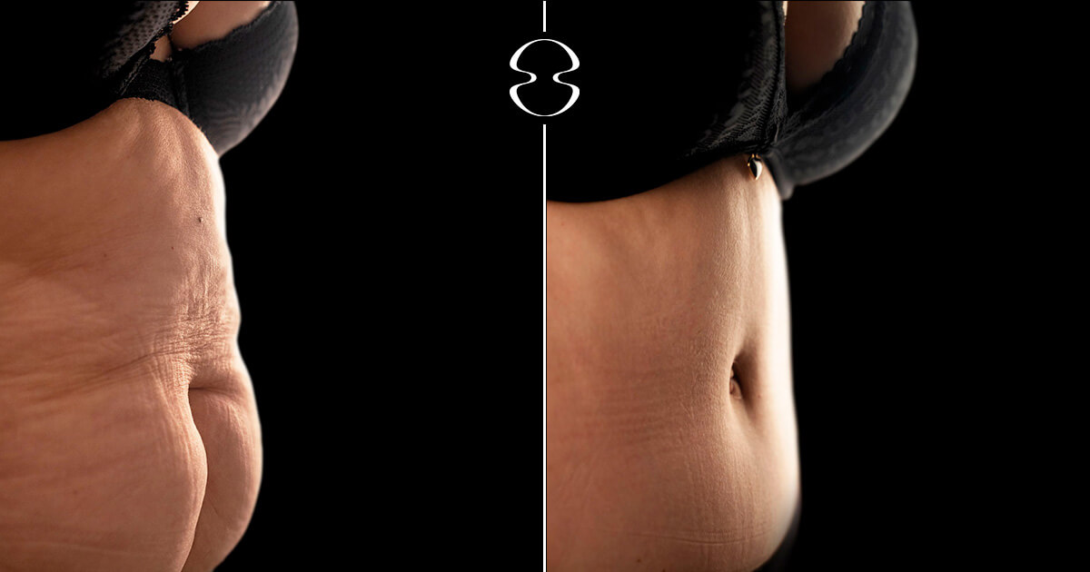 Lipoaspiração caso antes e depois