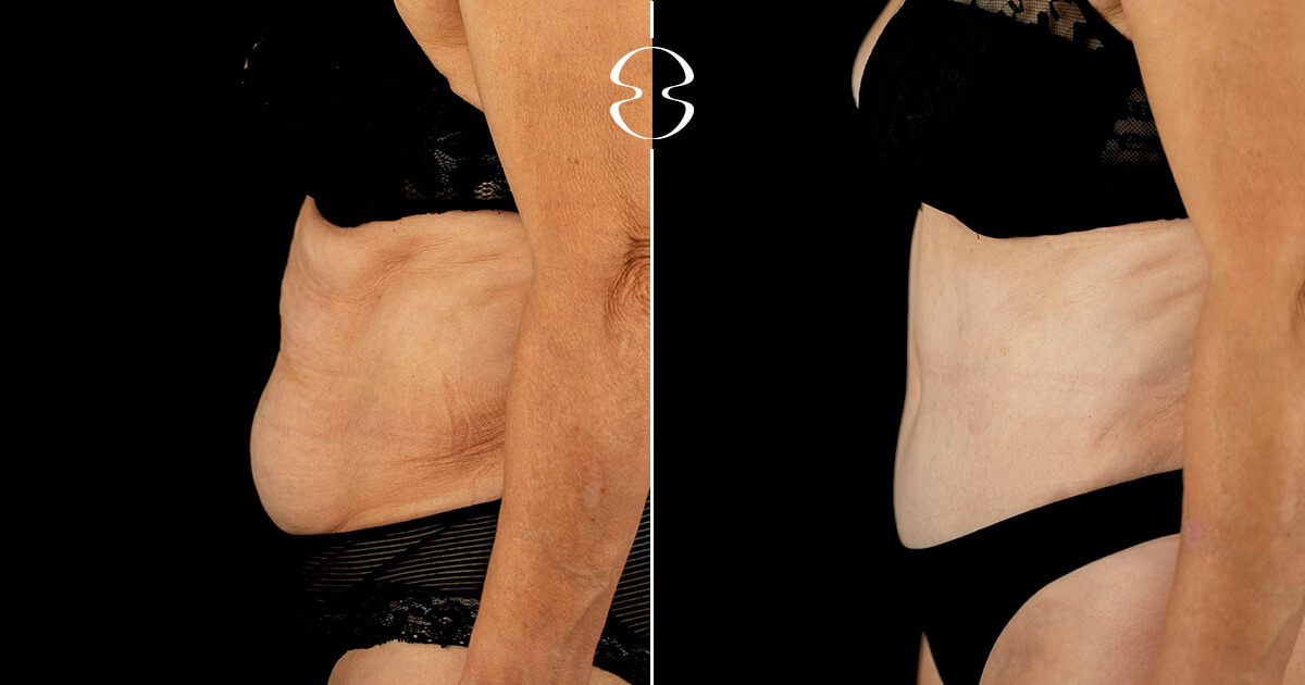 Lipoaspiração caso antes e depois