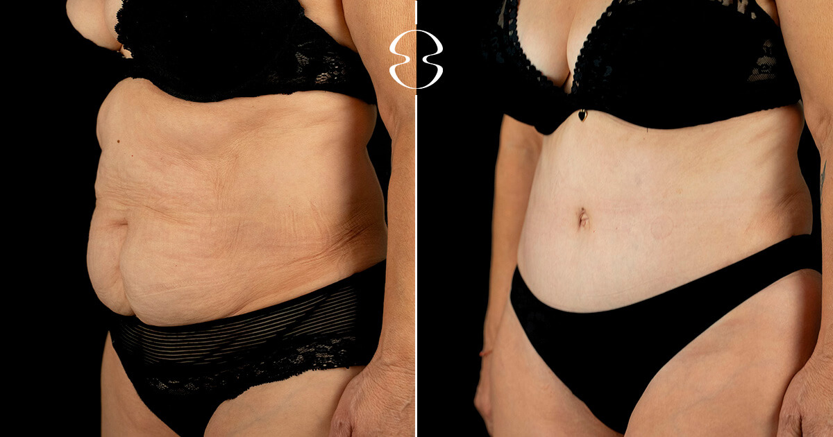 Lipoaspiração caso antes e depois