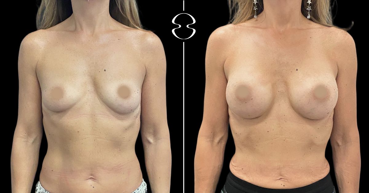 mamoplastia de aumento antes e depois