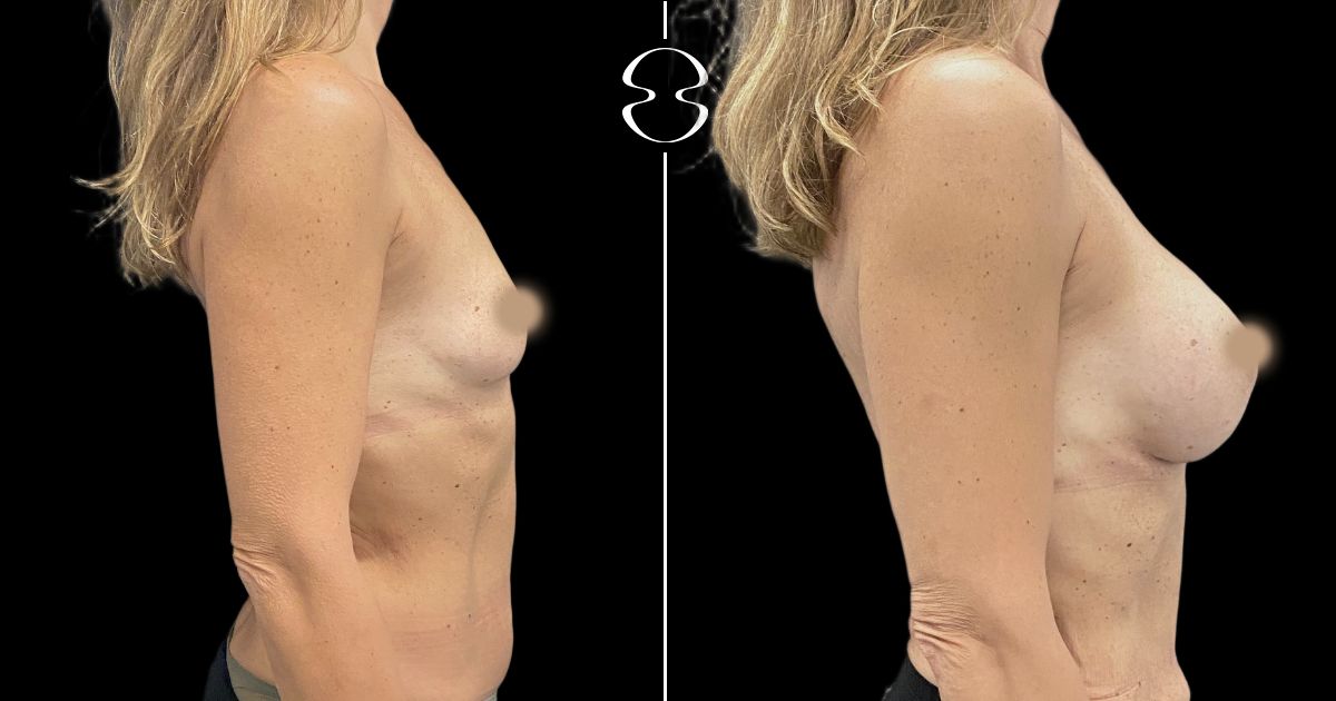 mamoplastia de aumento antes e depois
