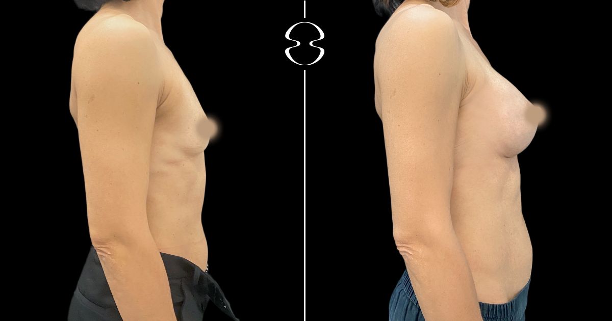 mamoplastia de aumento antes e depois 22657
