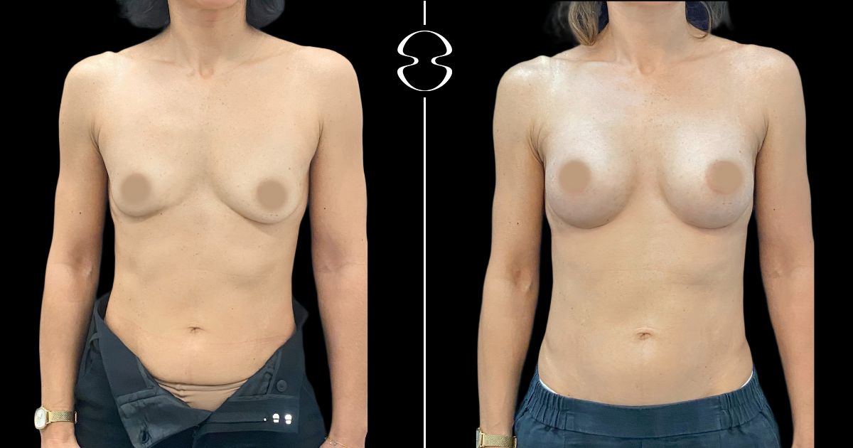 mamoplastia de aumento antes e depois 22657