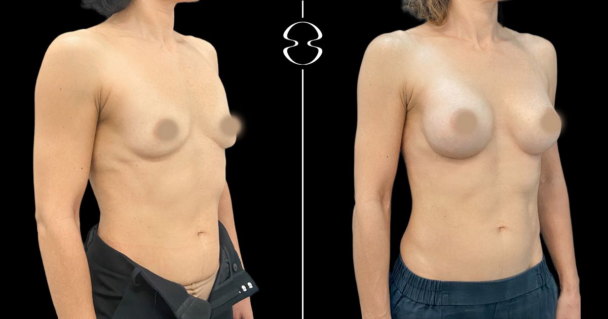 mamoplastia de aumento antes e depois 22657