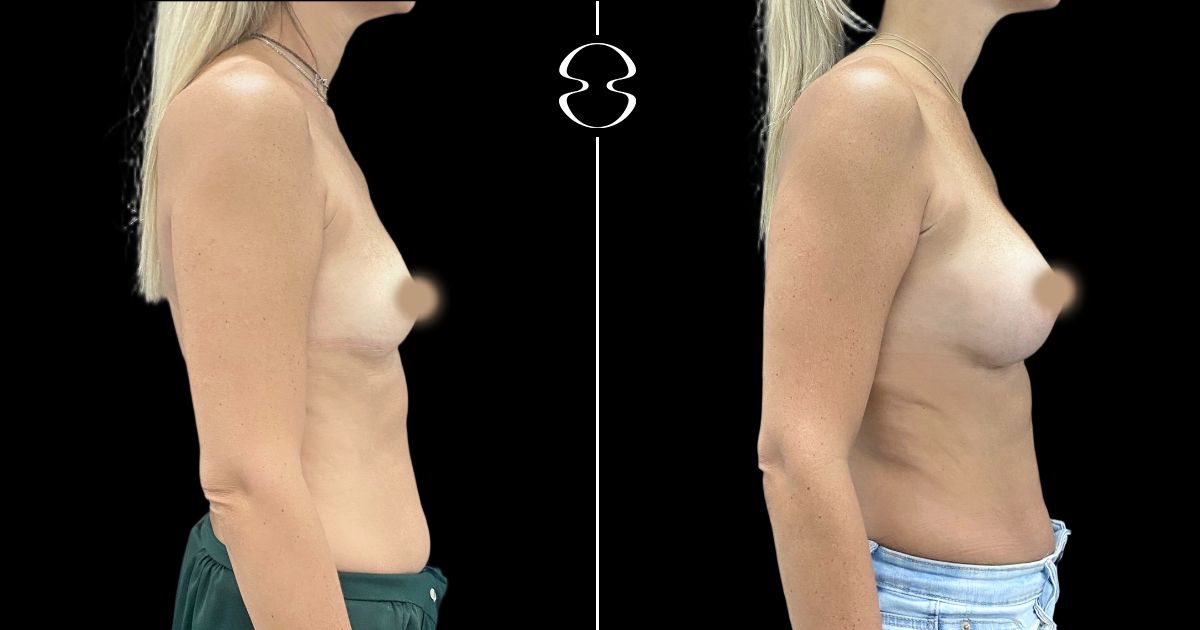 mamoplastia de aumento antes e depois