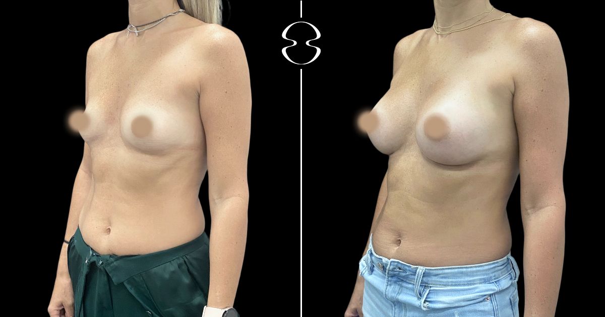 mamoplastia de aumento antes e depois