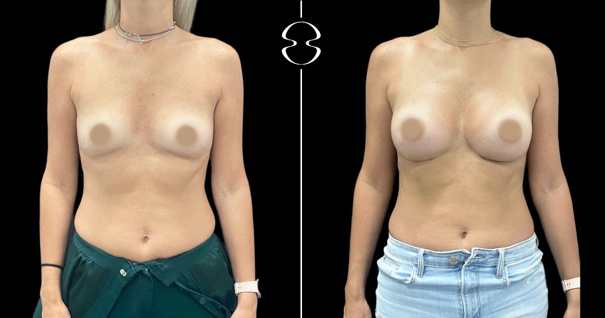 mamoplastia de aumento antes e depois