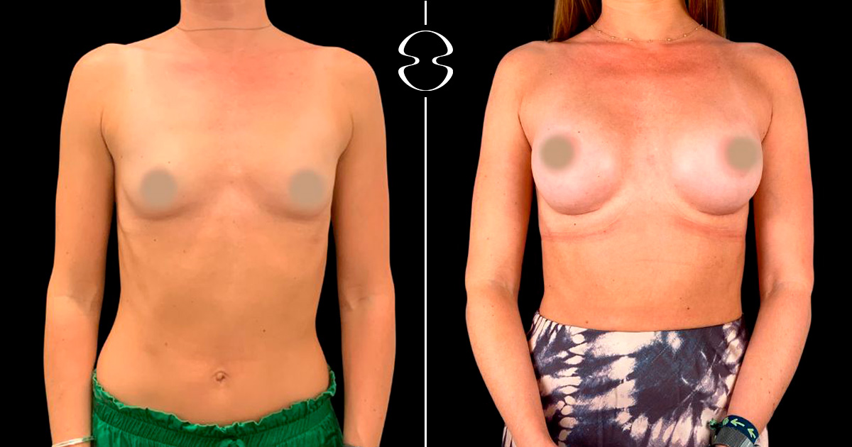 Mamoplastia de Aumento antes e depois