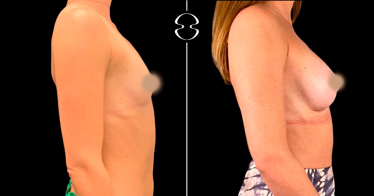 Mamoplastia de Aumento antes e depois
